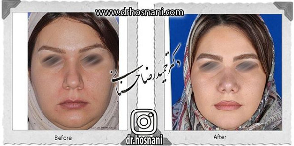  جراحی بینی -985