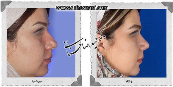  جراحی بینی -986