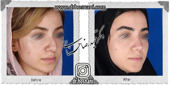  جراحی بینی -987