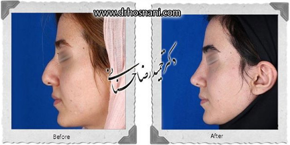  جراحی بینی -988