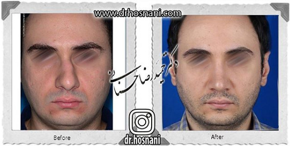 اصلاح انحراف بینی
