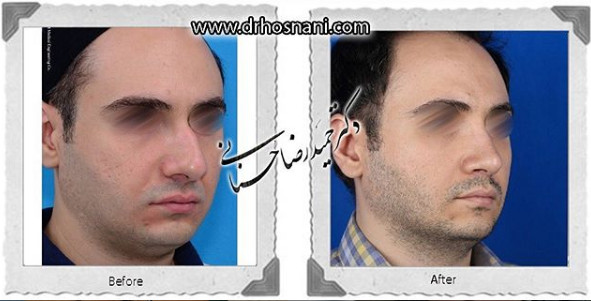 اصلاح انحراف بینی