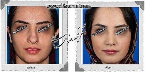 اصلاح انحراف بینی