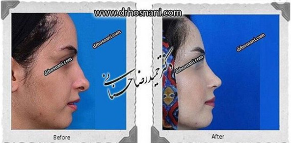 اصلاح انحراف بینی