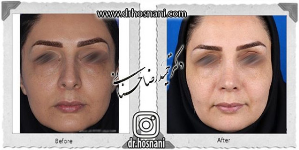 کاهش ارتفاع بینی
