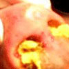 nasal