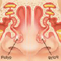 polyp