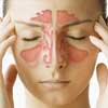 sinusitis