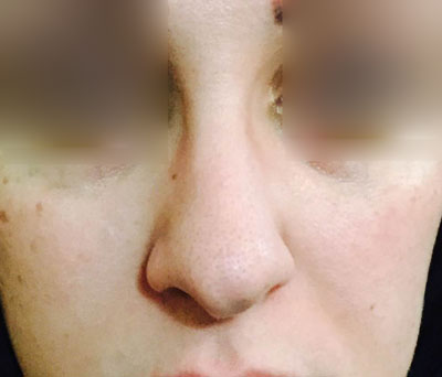 nose 3864  