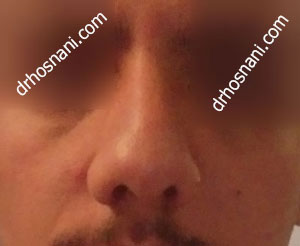 nose 3881  
