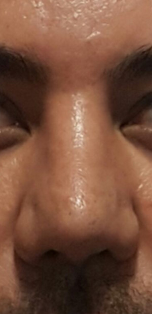 nose 5020  