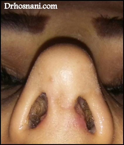 nose 5051  