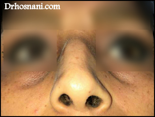nose 5078  