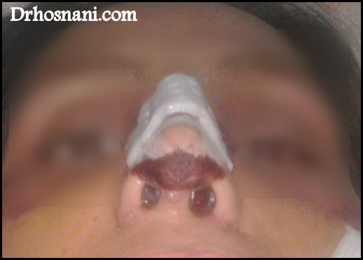 nose 5079  