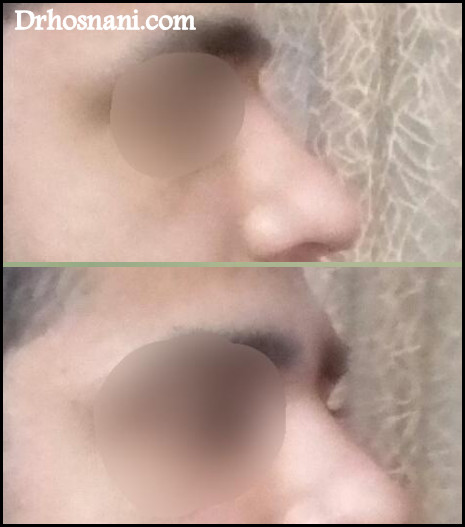 nose 5276  