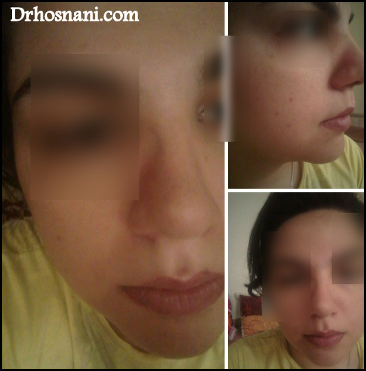 nose 5371  