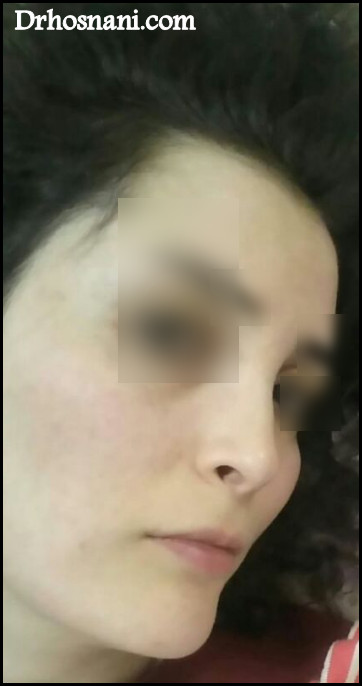nose 5388  
