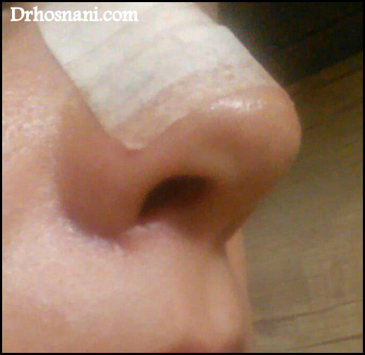 nose 5396  