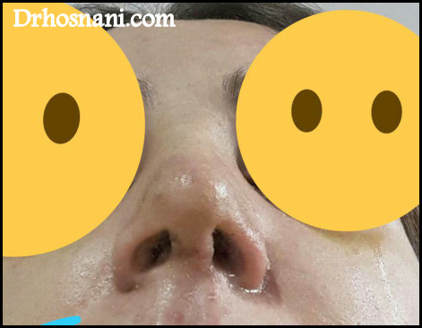 nose 5414  