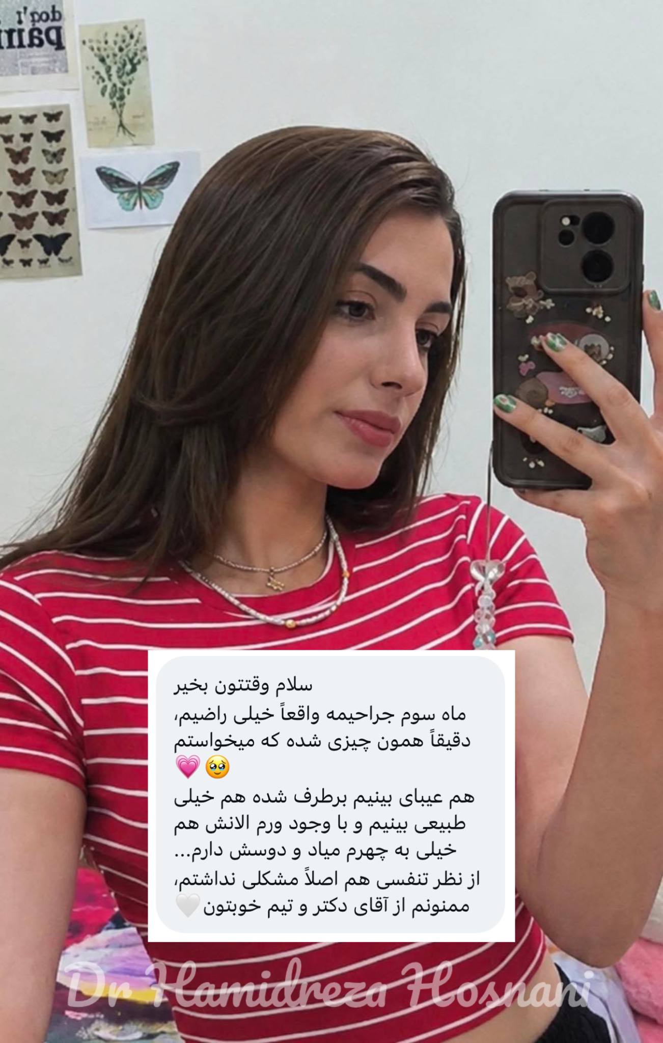 سلفی آینه‌ای دختر جوان بعد از عمل بینی با تیشرت راه‌راه قرمز، به همراه پیام رضایتش از نتیجه جراحی، تنفس راحت و فرم طبیعی بینی پیش دکتر حمیدرضا حسنانی.