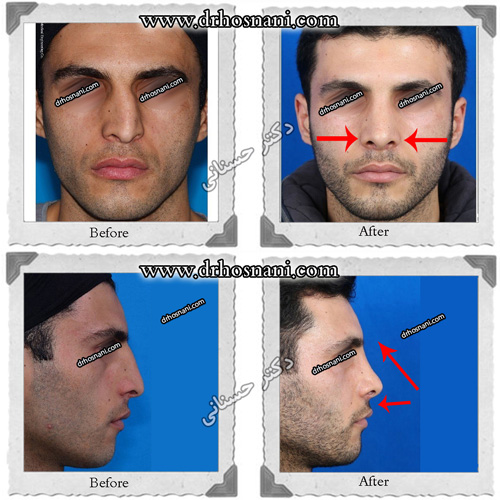 3d nose size reduction og