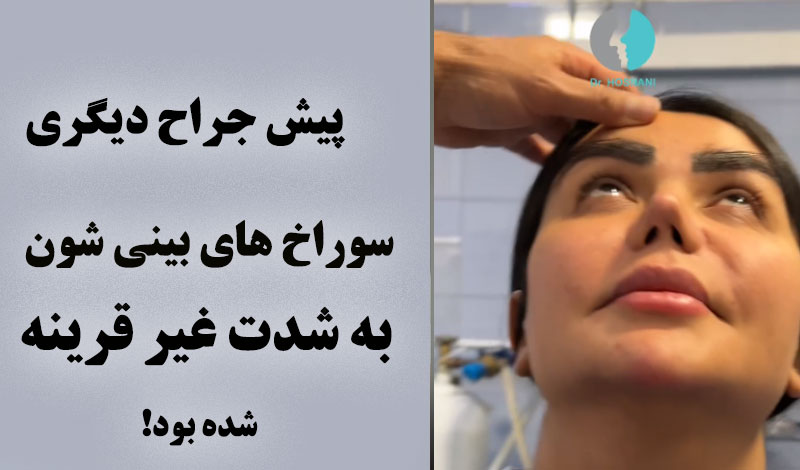 ترمیم بینی پس از دو جراحی قبلی + نتیجه بعد از برداشتن گچ!
