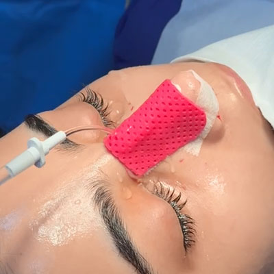 Cooling the thermoplastic sheet with water to stabilize the nasal splint
