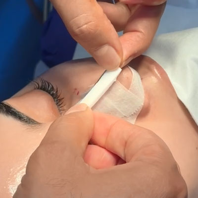 Nasal splint second stage applying double sided tape