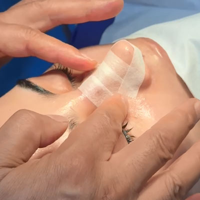 Thermoplastic splint the first stage of nasal taping