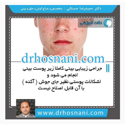 acne cannot be fixed