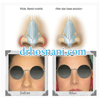 alar base excision
