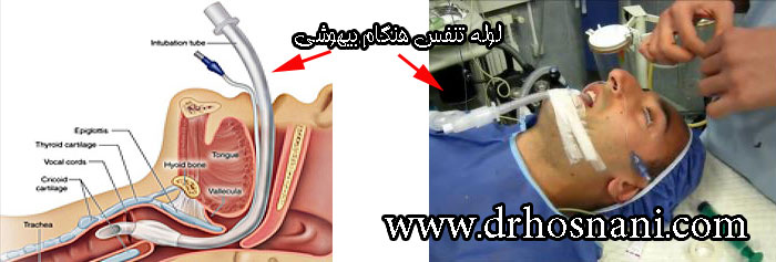 anesthesia tube