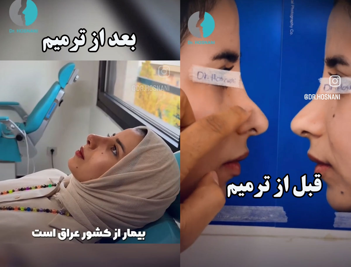 نتیجه جراحی بینی ترمیمی خانم عراقی یک هفته بعد از عمل