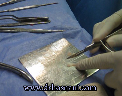 گرافت غضروفی