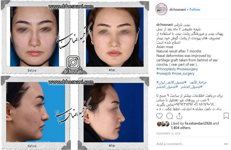 asian nose rhinoplasty