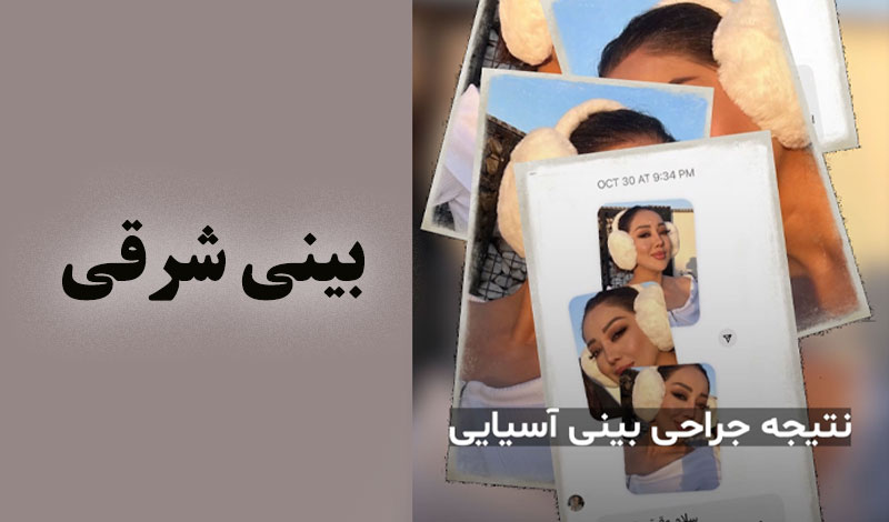 نتیجه جراحی خانم با بینی شرقی
