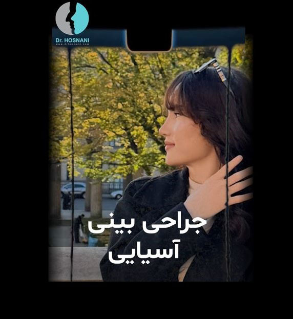 نتیجه جراحی بینی آسیایی