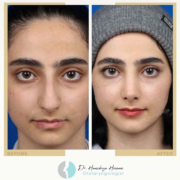 قبل و بعد عمل بینی با رعایت استانداردهای زیبایی بینی
