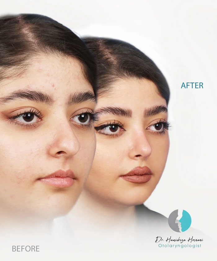 جراحی بینی طبیعی از نمای سه رخ