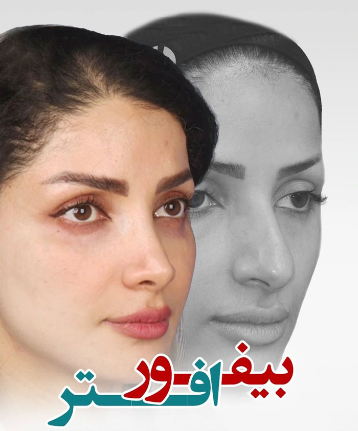 جراحی بینی استخوانی با پوست نازک