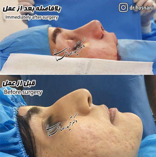 رفع قوز بینی و کاهش پایه پره های بینی بلافاصله بعد از عمل