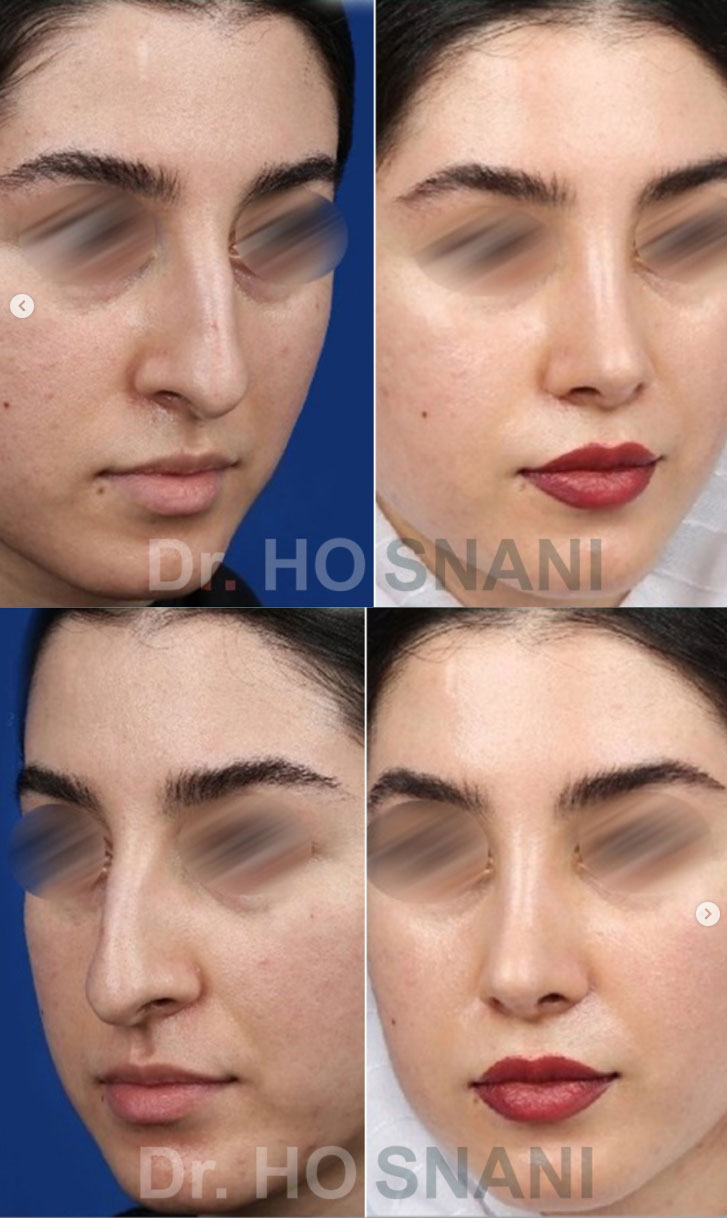 جراحی بینی استخوانی
