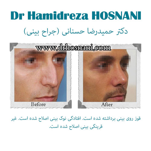 bony nose surgery og