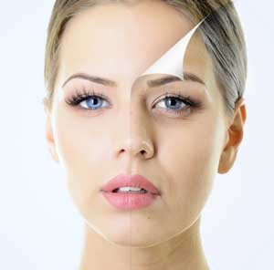 botox