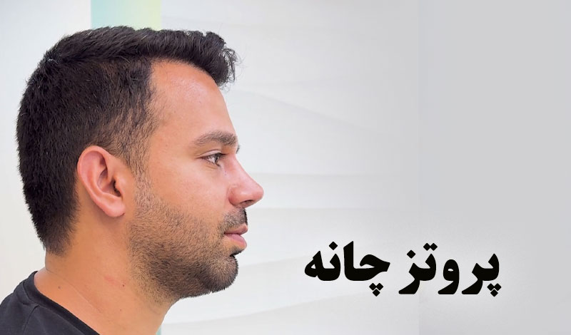 از استرالیا تا ایران برای بینی مردانه طبیعی؛ نتیجه رو ببین!