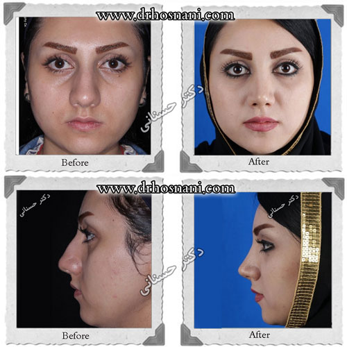 cartilaginous thick skin nose og