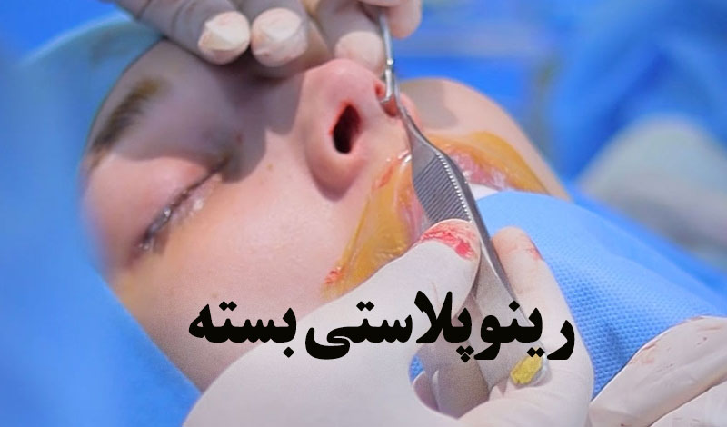 رینوپلاستی بسته روشی از جراحی بینی است