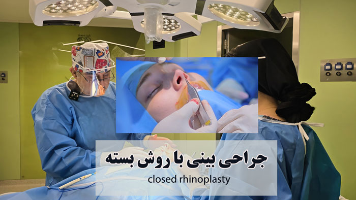 جراحی بینی با روش بسته: دکتر حسنانی بهترین جراح بینی از دید کاربران