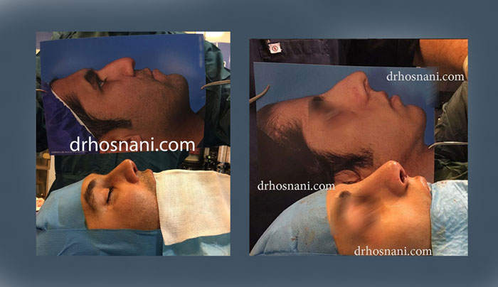 comparison of nasal projection in women and men