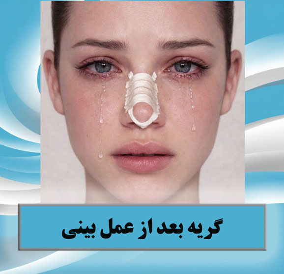 گریه بعد از عمل بینی